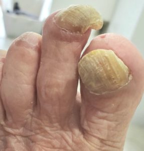 爪が厚くて切れなくない 高齢者 老人性肥厚 ドイツ式フットケアサロンseila セイラ